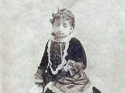 Женщина-кукла Лусия Сарате - результат генетического сбоя
